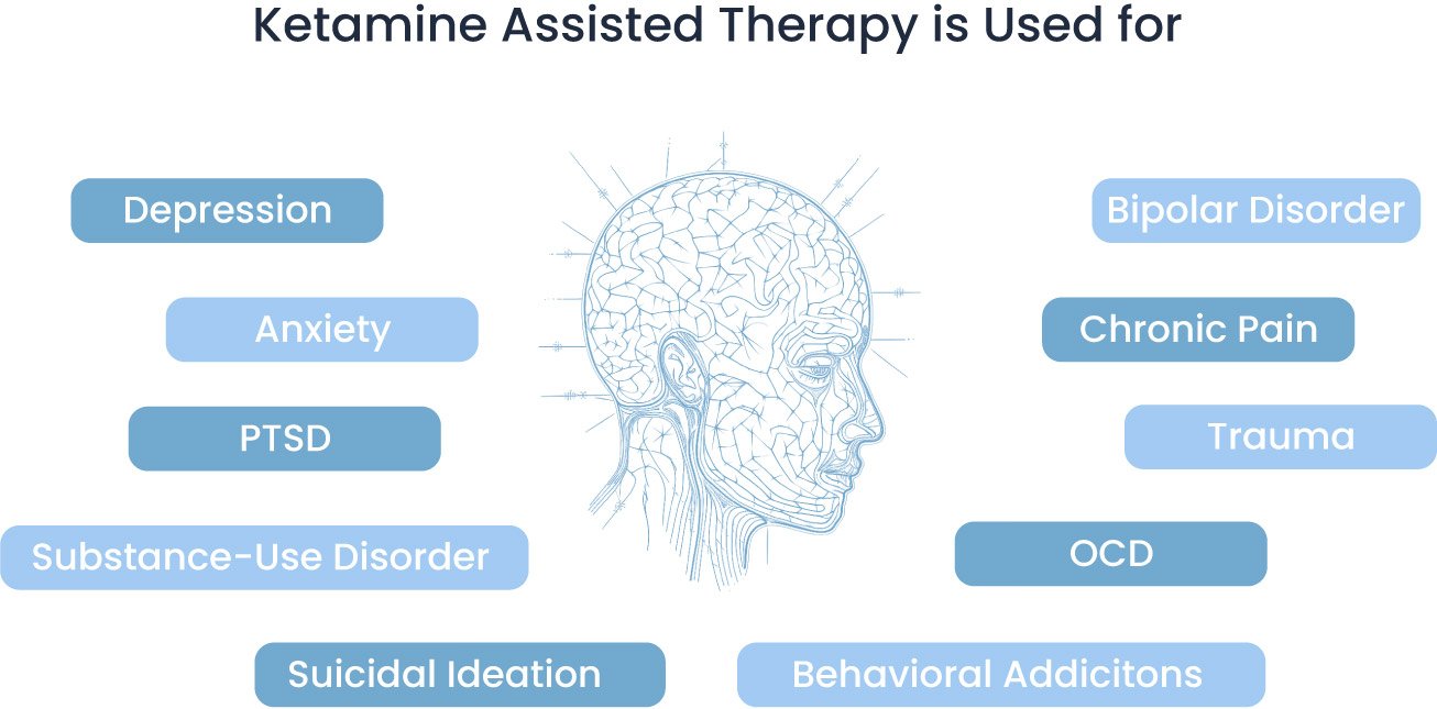 Ketamine Therapy Diagram